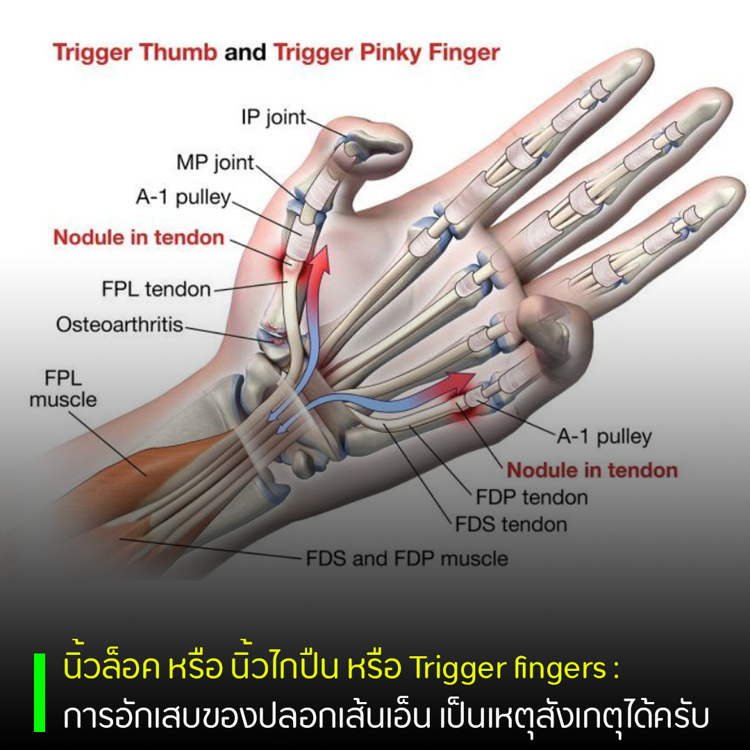 รักษาโรค “นิ้วล็อค” แบบ “ไม่ผ่าตัด” พรหมวิหารคลินิก