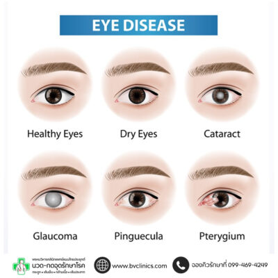 รูปที่ 1 อาการแสดงโรคต้อชนิดต่าง ๆดัดแปลงรูปจาก https://www.bangkokhospital.com/content/beware-of-4-eye-diseases